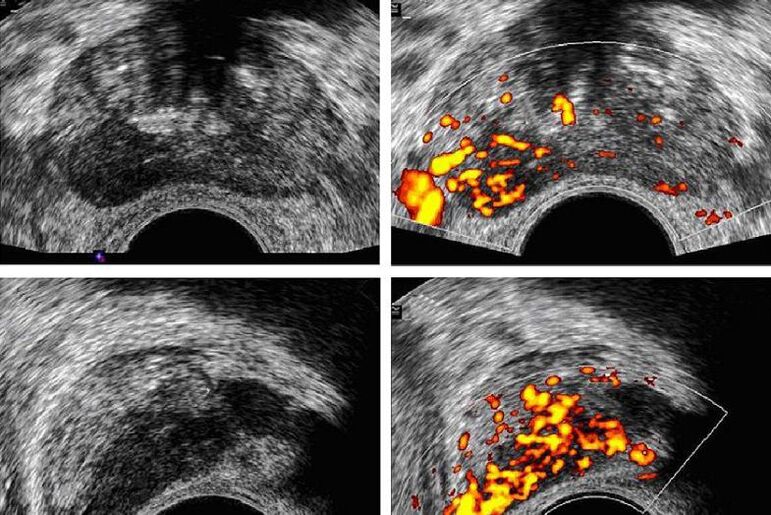 dijagnoza raka prostate