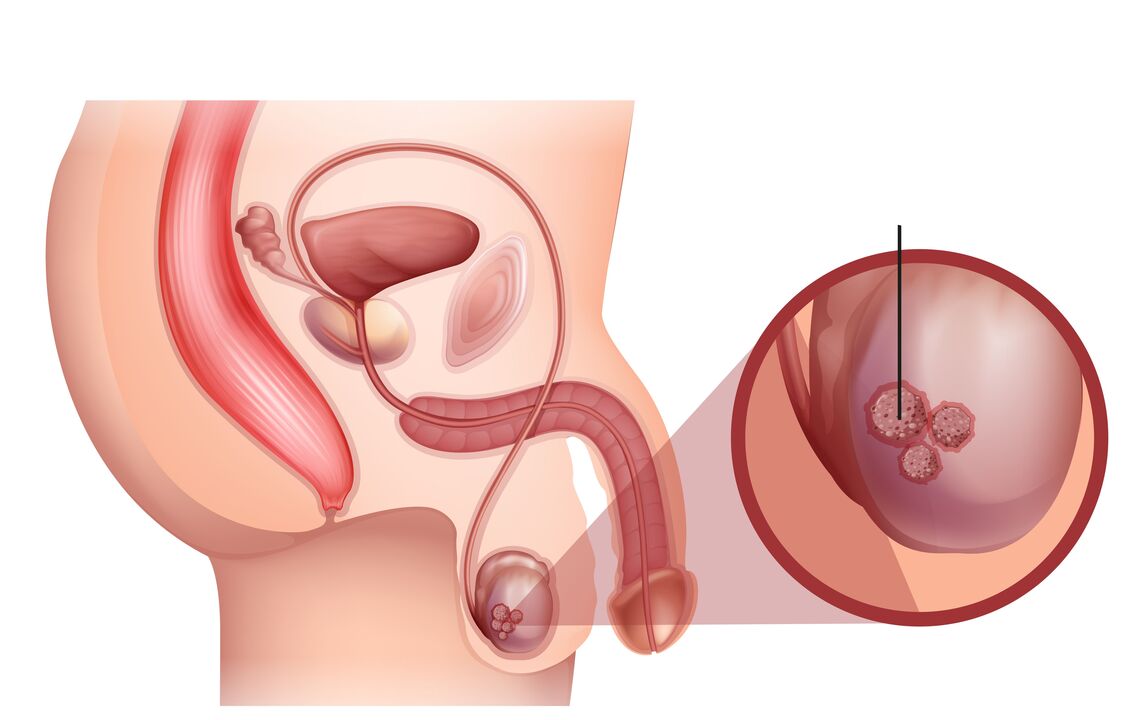 znakovi raka prostate