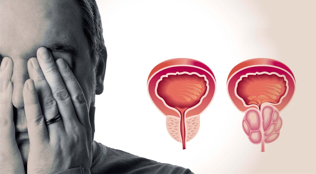 kronični prostatitis kod muškaraca