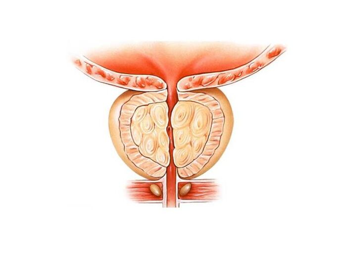 liječenje prostatitisa s narodnim lijekovima