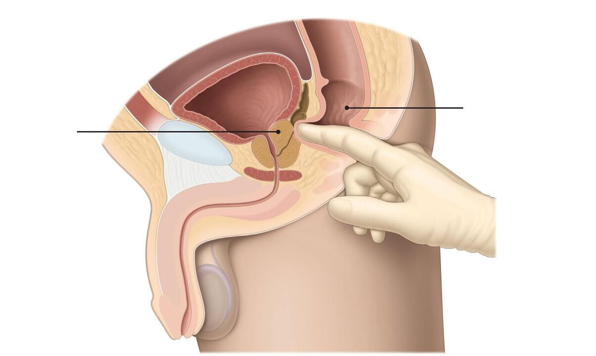 tehnika masaže prostate