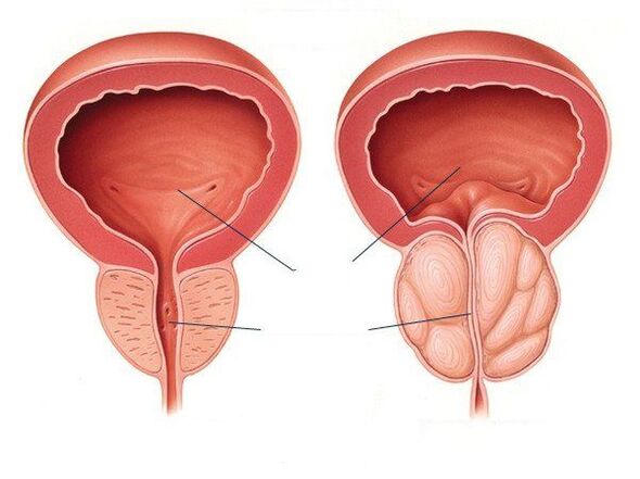 zdrave i bolesne prostate