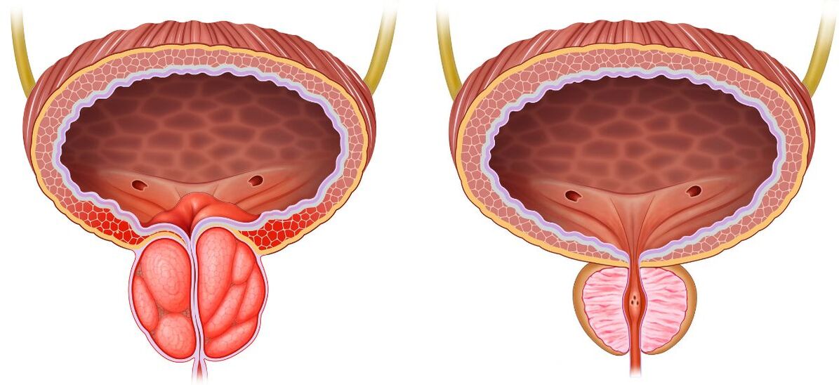 zdrave i bolesne prostate