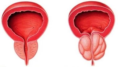 zdrava i upaljena prostata s prostatitisom